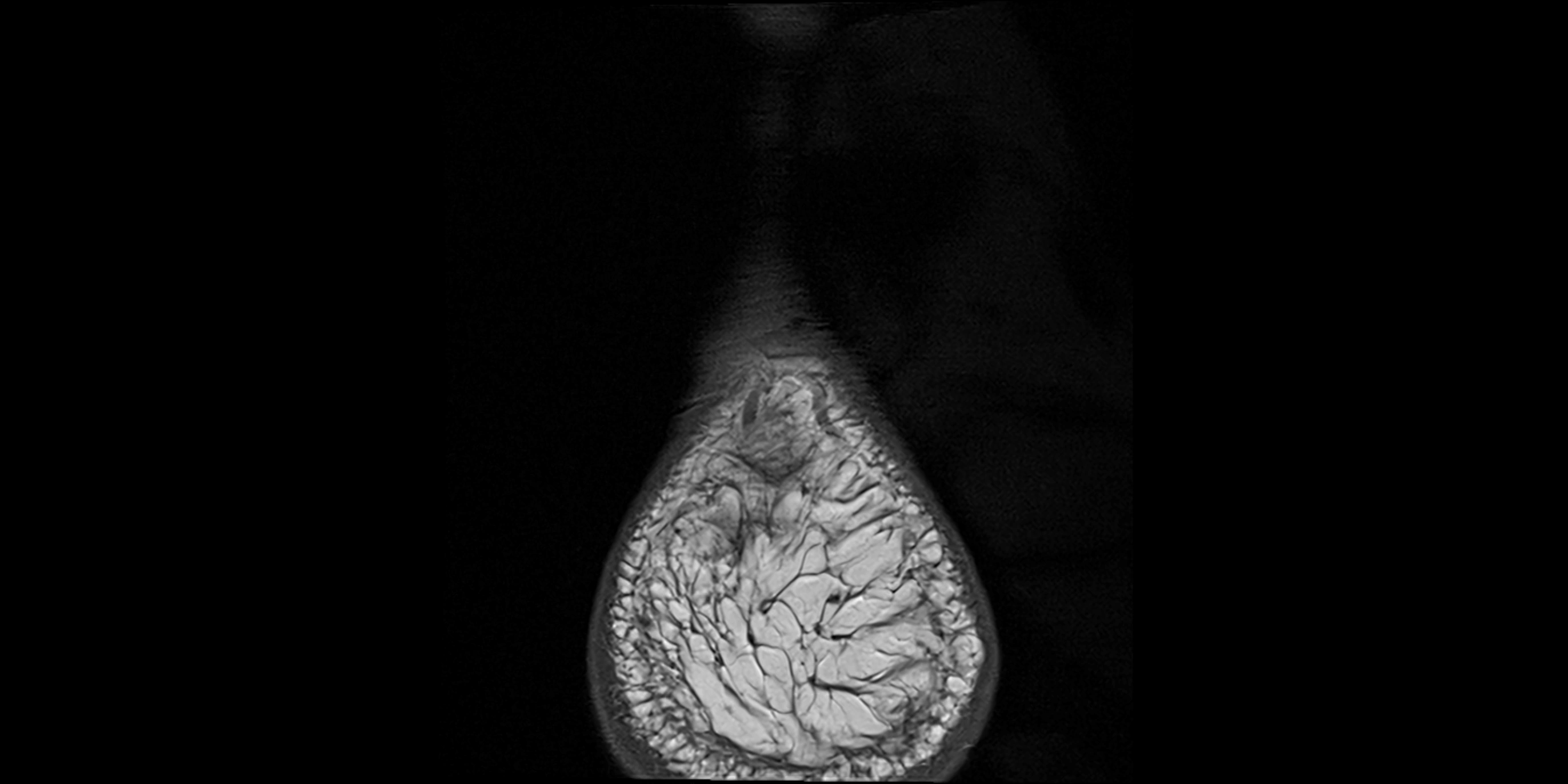 MRI Ankle coronal ligaments cross sectional anatomy 3T  radiology  image-img-00001-00033.webp